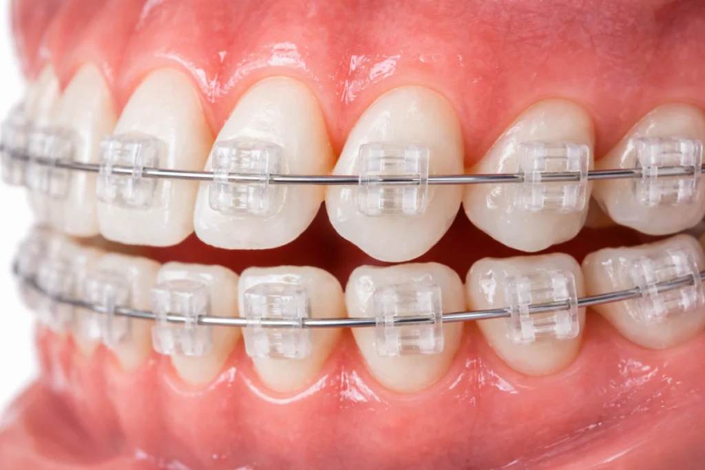 bagues autoligaturant ceramique charenton le pont Orthodontie de l'adulte Dr Déborah Fellous | Orthodontiste à Charenton-le-Pont