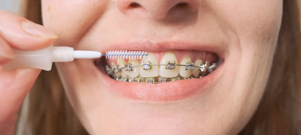 Orthodontie de l’adolescent Dr Déborah Fellous | Orthodontiste à Charenton-le-Pont