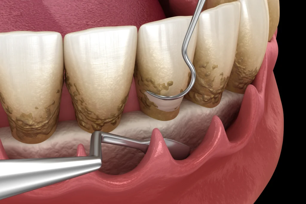 chirurgie assainissement parodontal Soins des gencives chirurgicaux Dr Johan Cinçon - Chirurgien-dentiste à La Teste-de-Buch