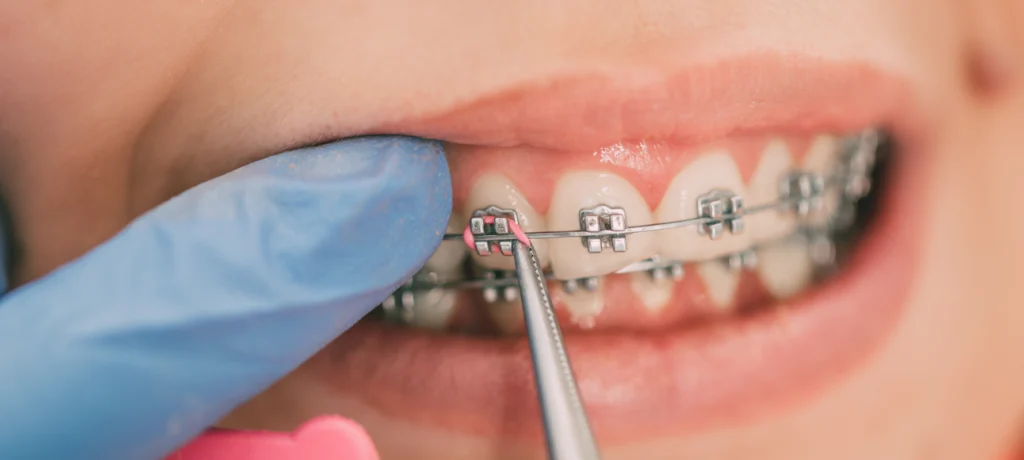 Port d'élastiques inter-arcades Dr Déborah Fellous | Orthodontiste à Charenton-le-Pont