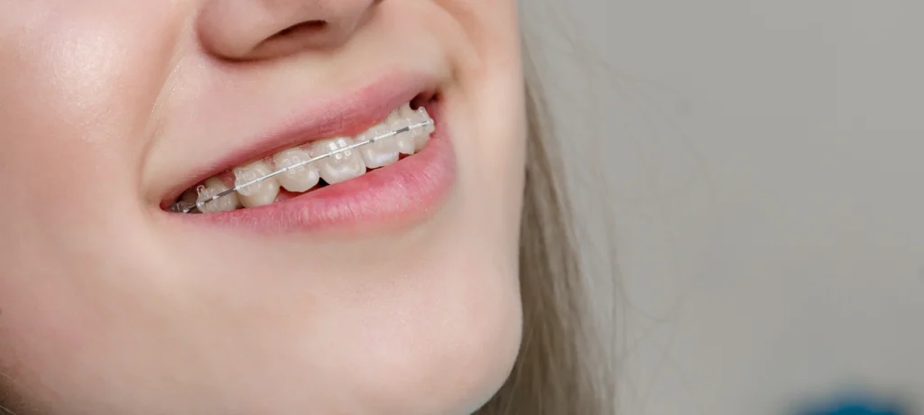 Orthodontie de l’adolescent Dr Déborah Fellous | Orthodontiste à Charenton-le-Pont