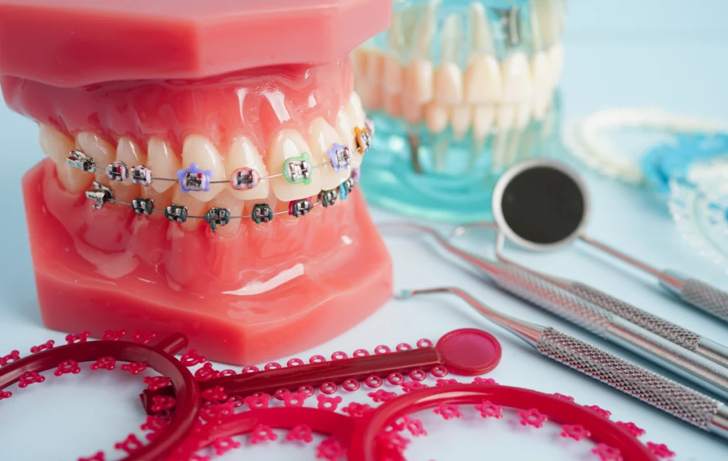 Port d&rsquo;élastiques inter-arcades