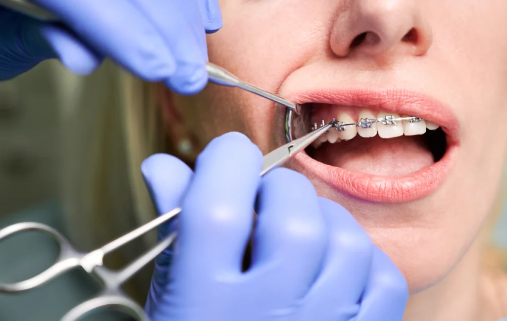 Incidents en orthodontie Dr Déborah Fellous | Orthodontiste à Charenton-le-Pont